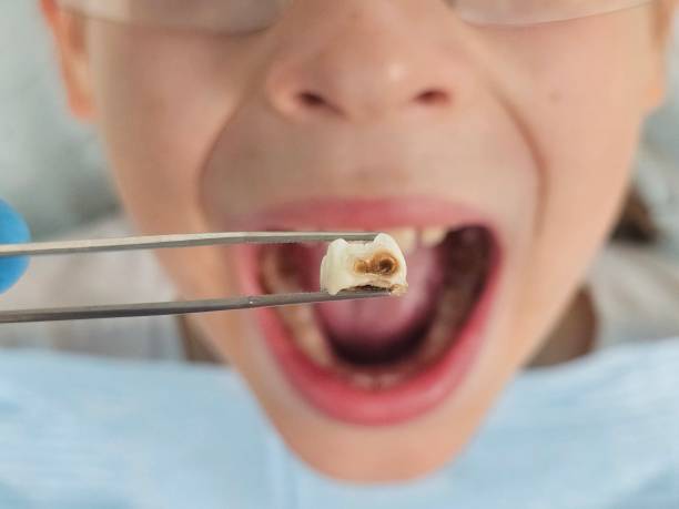Best Urgent Care for Lost Fillings or Crowns in Sesser, IL